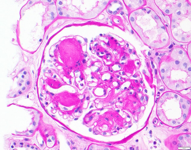 Nodular glomerulosclerosis (diabetic) five years posttransplant