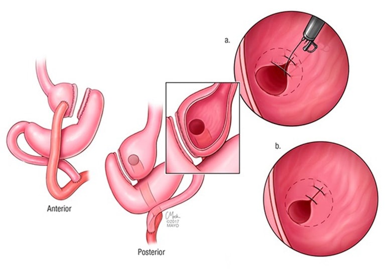 Endoscopic Options for Weight Loss