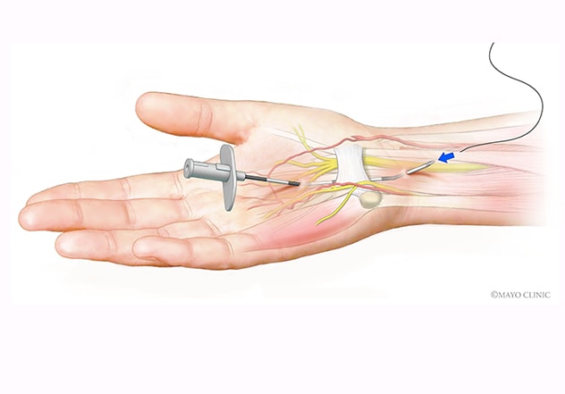 Carpal tunnel release Information