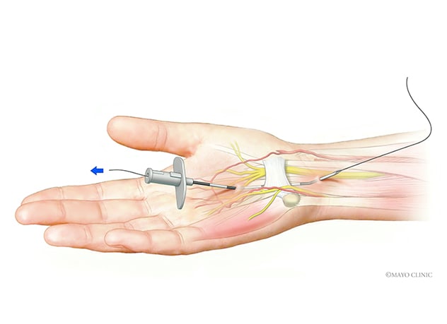 New approaches to carpal tunnel release and treatment of tendinopathy -  Mayo Clinic