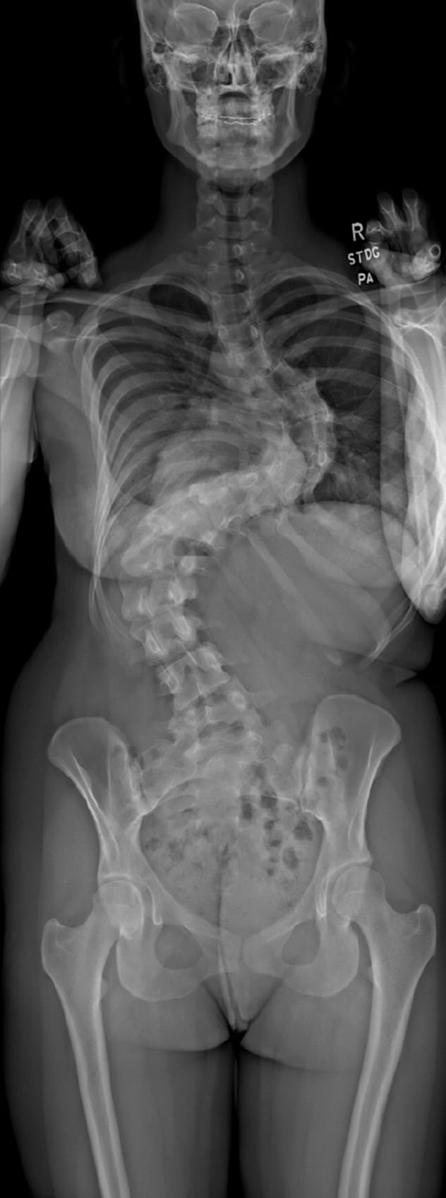 Preoperative radiograph shows scoliosis