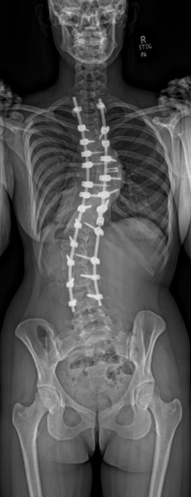 Radiografía postoperatoria muestra corrección