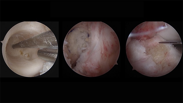 Stage I bone grafting