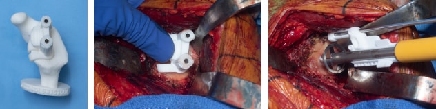 3D surgical and depth control guides