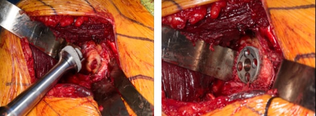 Augmented glenoid baseplate