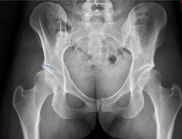 Hip dysplasia with an associated labral tear