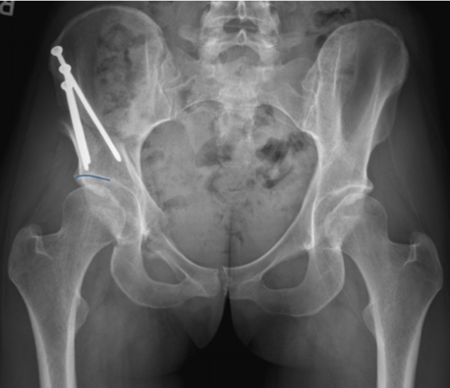 Normal alignment of the acetabulum