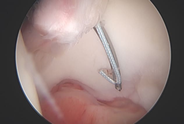 Paso de sutura durante la reparación del labrum