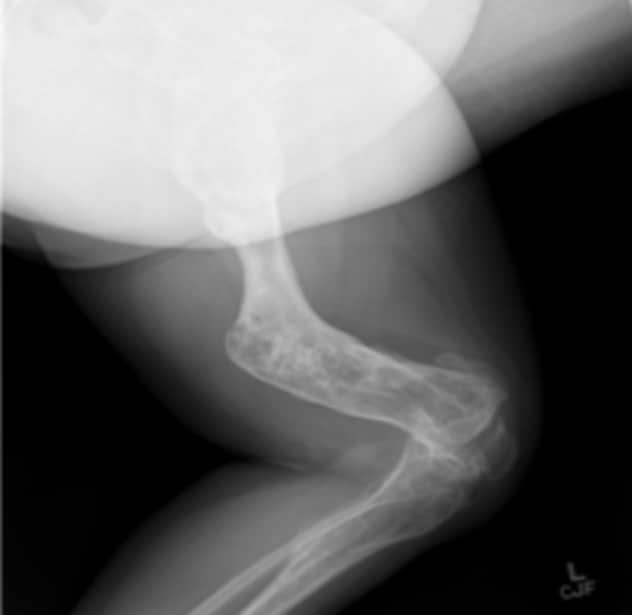 الأشعة السينية لامرأة تبلغ من العمر 55 عامًا تعاني من داء أوليير