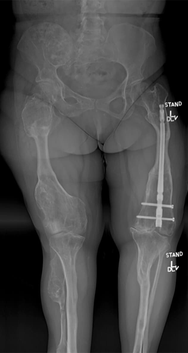 Treatment of Ollier's disease