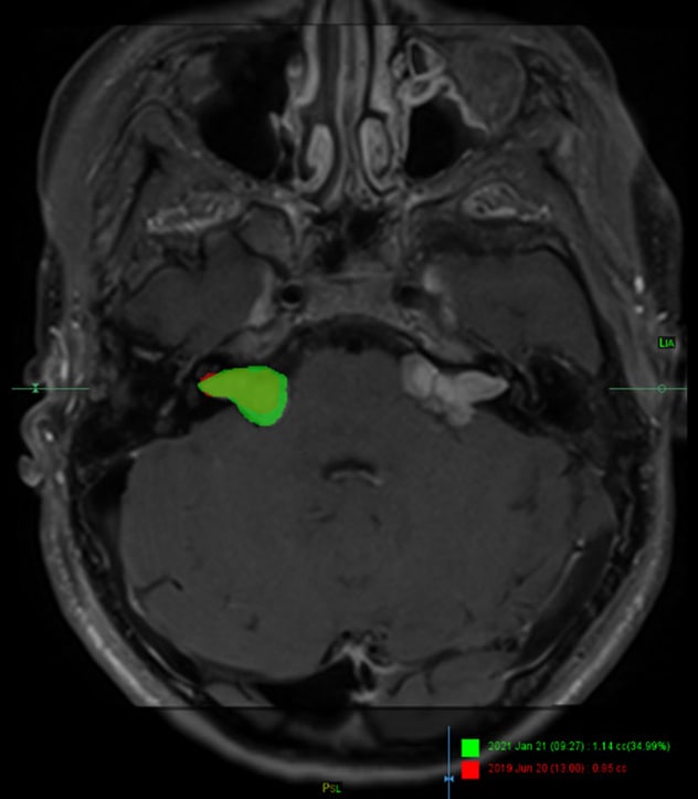 Growth of bilateral vestibular schwannomas