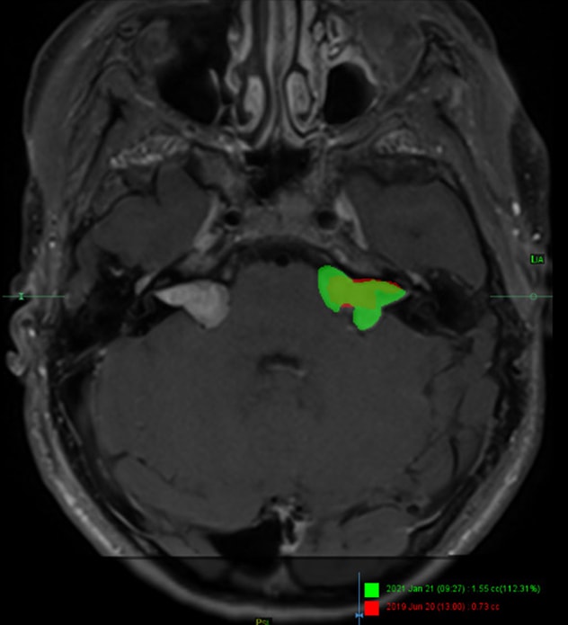 Enhanced monitoring of tumor growth