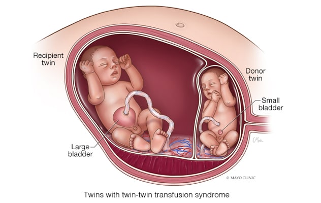 Twin-twin transfusion syndrome