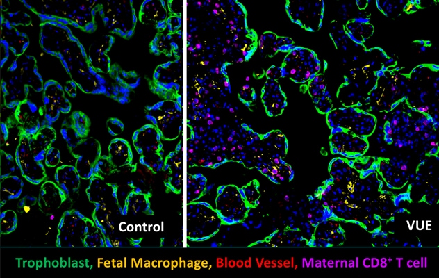 Células T maternas en la placenta fetal durante el diagnóstico de villitis de origen desconocido