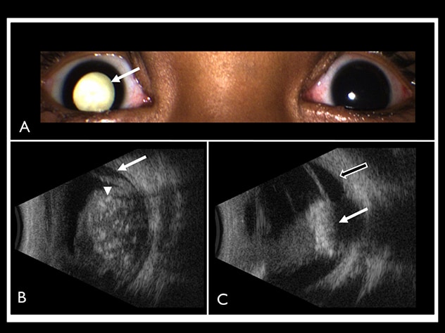 Tratamiento de retinoblastoma