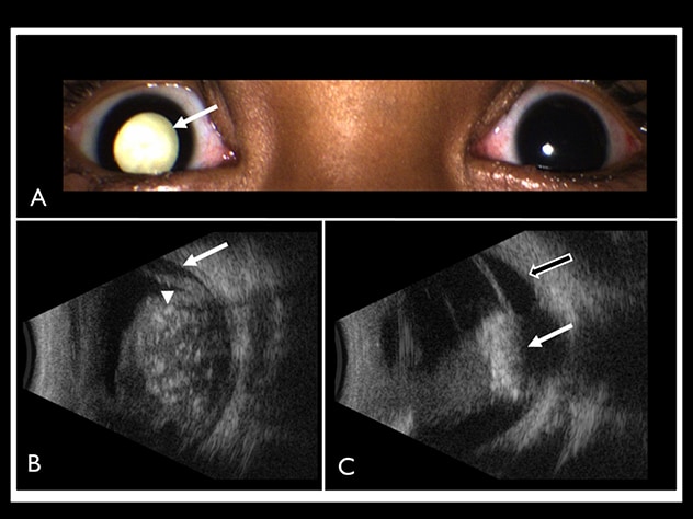 Retinoblastoma treatment