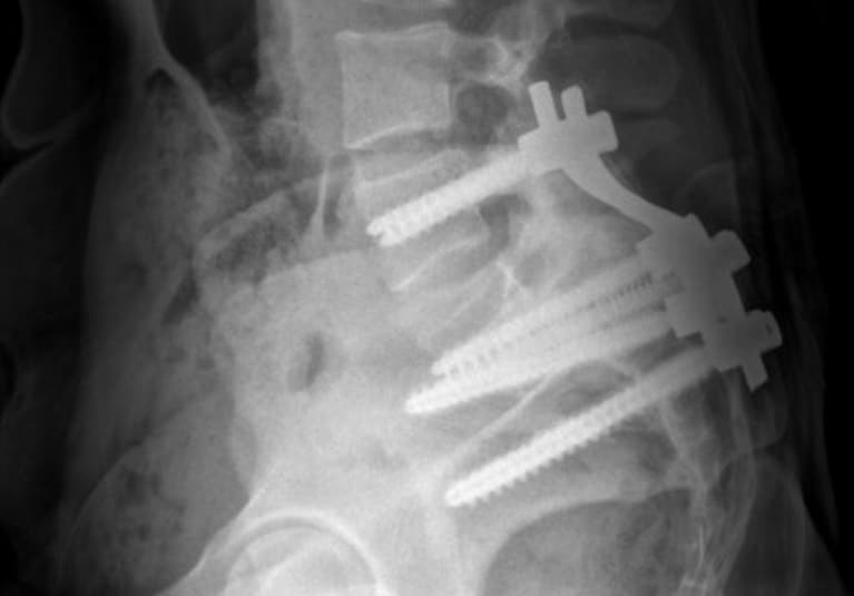 thoracic spondylolisthesis symptoms