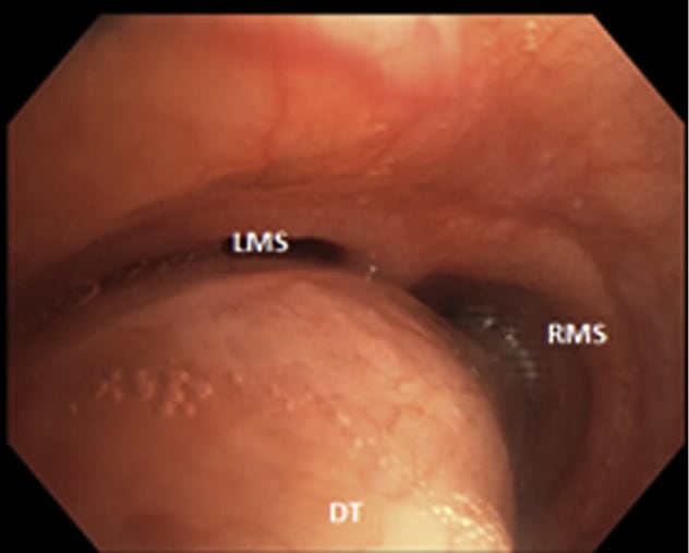 Expiration view of the distal trachea