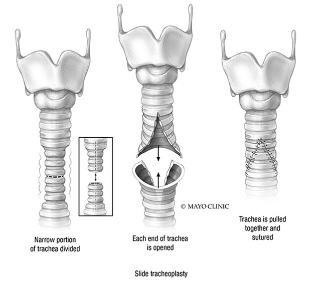 Slide tracheoplasty