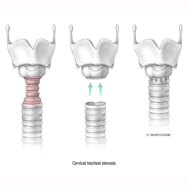 Pediatric tracheal surgery A multidisciplinary team approach to