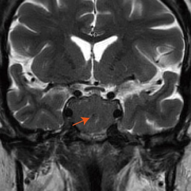 Hipointensidad con manchas dentro del tumor