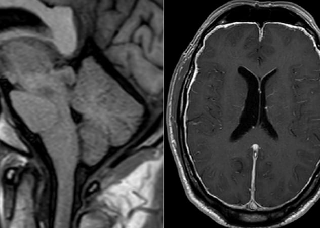 Cerebral spinal fluid (CSF)-venous fistula