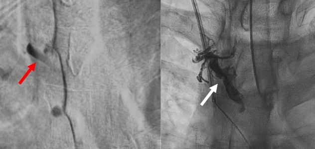 Embolization of CSF-venous fistula