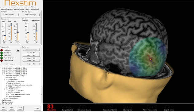 Targeting seizure origins