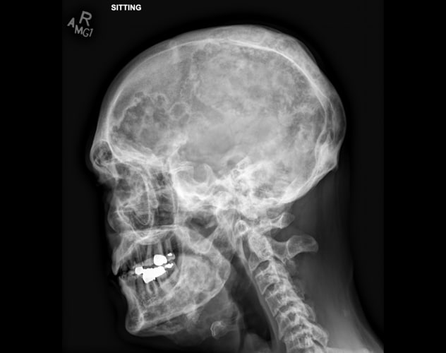 Polyostotic fibrous dysplasia involving the calvaria and mandible