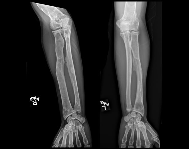 Polyostotic fibrous dysplasia involving the forearms