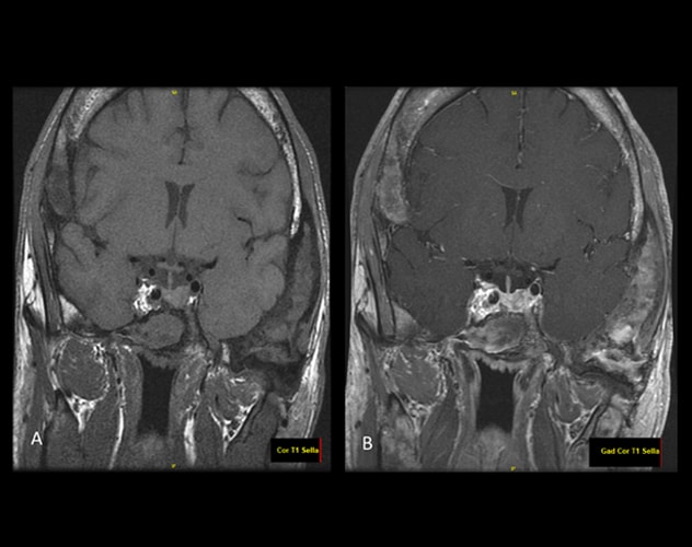 Resonancia magnética de la glándula pituitaria sin contraste intravenoso (A) y con contraste intravenoso (B)