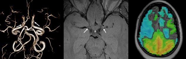 Detailed moyamoya imaging protocol