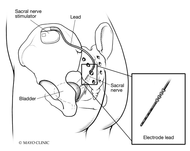Sacral nerve modulation device