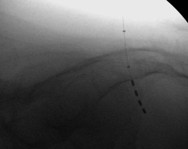 Sacral nerve stimulator placement