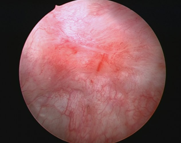 Bladder carcinoma in situ