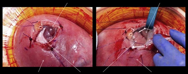 In utero myelomeningocele repair