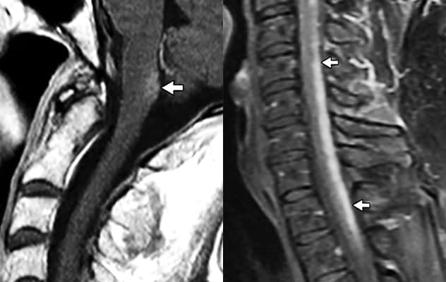 Lesions in the AQP4-enriched postrema