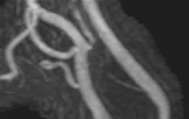 Carotid plaque without stenosis