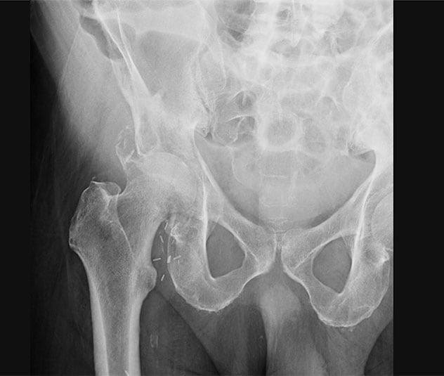 病理性髋臼骨折和股骨头上移