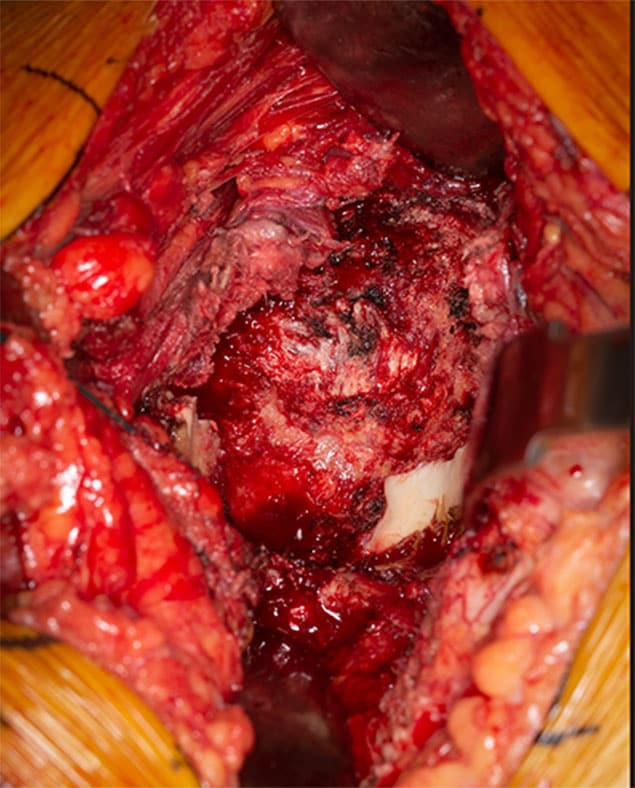 Pérdida de la masa ósea acetabular superior y posterior.