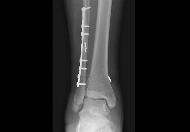 Radiografía posoperatoria de seguimiento