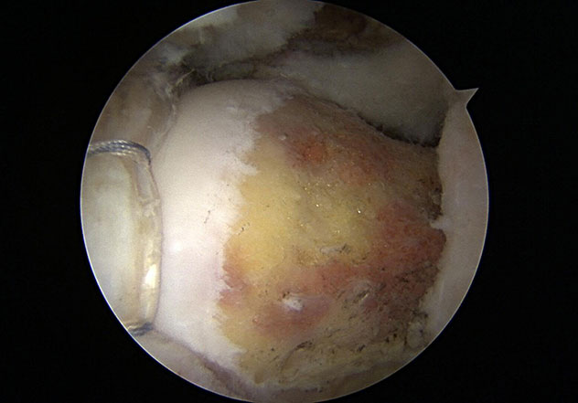 Artroscopia de cadera