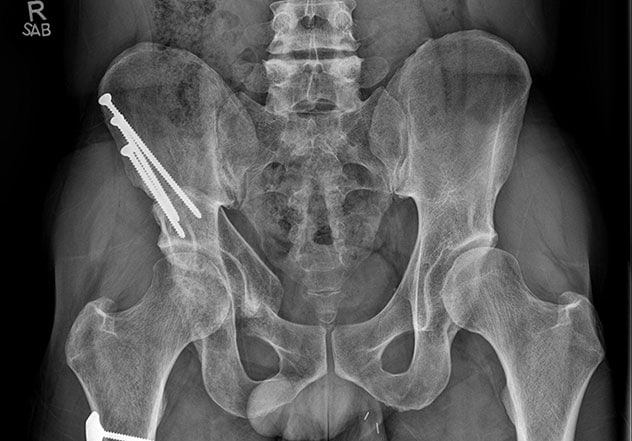 Corrección cuatro meses después del tratamiento