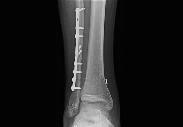 Long-term follow-up radiograph