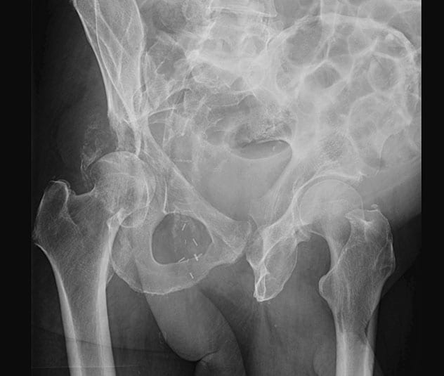 Pathological acetabular fracture with loss of the posterior wall and posterior column