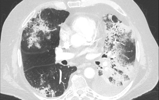 Ground-glass and consolidative opacities