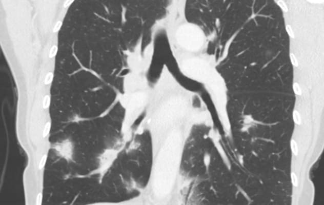 Pulmonary nodules and lymphadenopathy