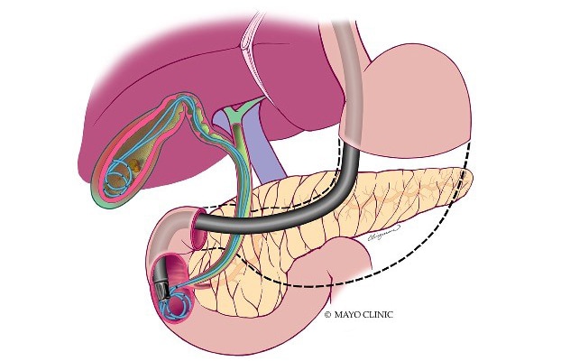 Endoscopic retrograde cholangiopancreatography-guided transpapillary gallbladder drainage (ERGD)
