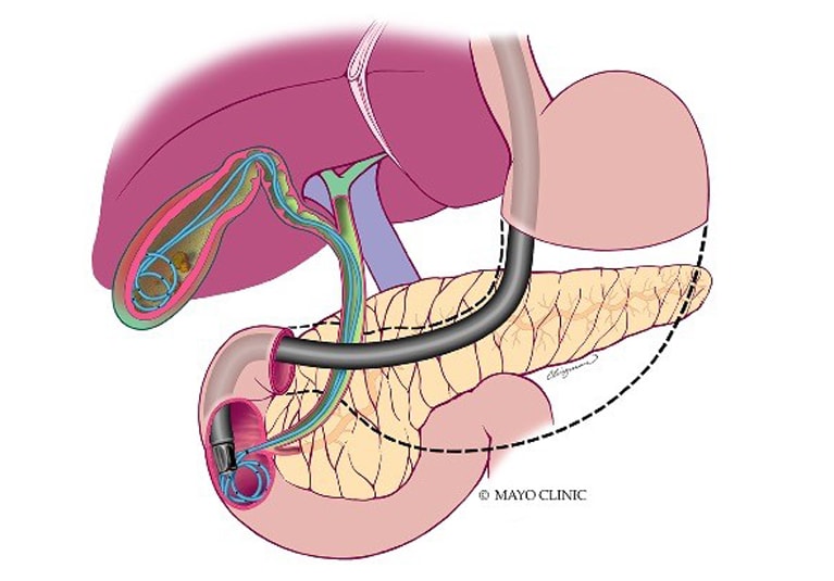 Gallbladder Removal Laparoscopic Surgery Patient Education - YouTube