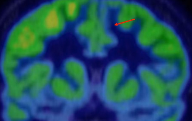 Metabolic abnormality associated with seizure origin